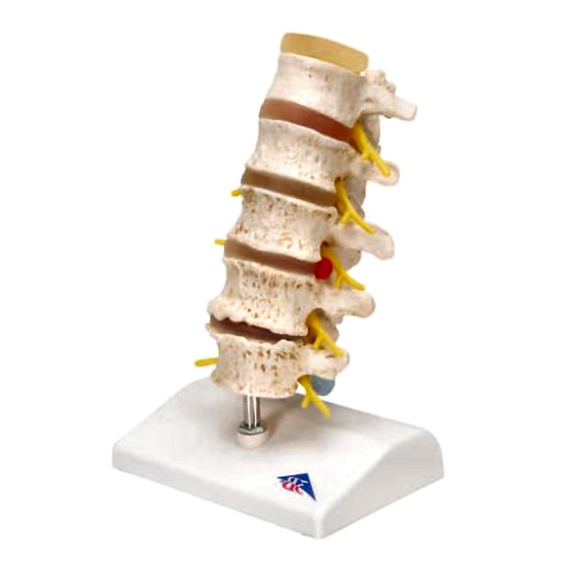 Vertebra Lumbar Spine Anatomical Model - Degenerative Changes Disc Protrusions Disassemblable 3B Scientific