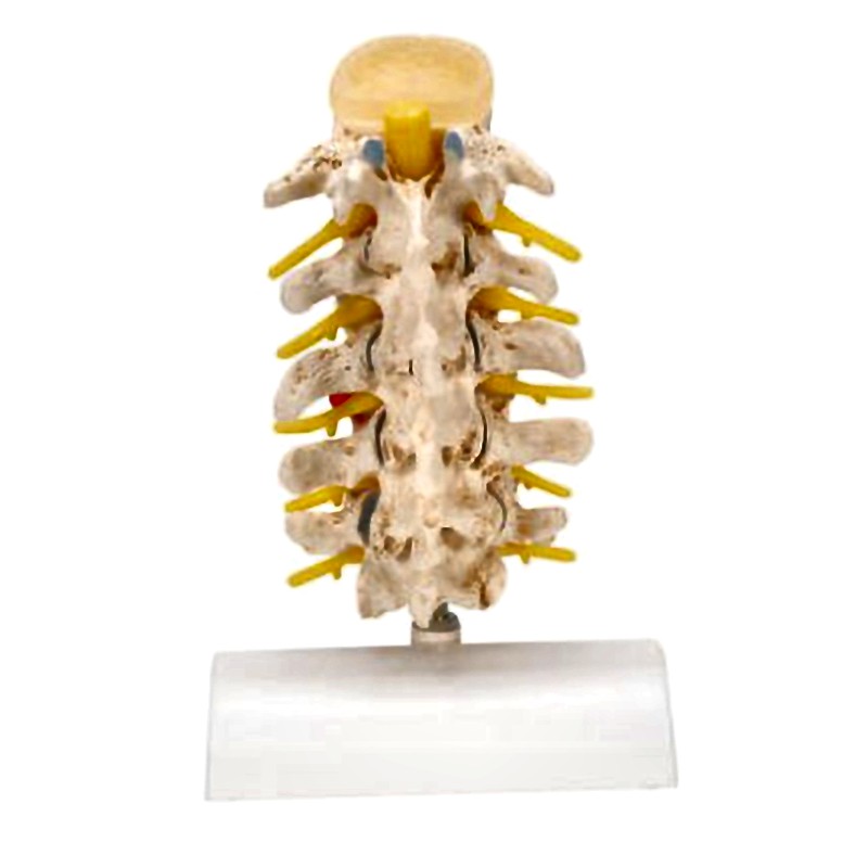 Vertebra Lumbar Spine Anatomical Model - Degenerative Changes Disc Protrusions Disassemblable 3B Scientific