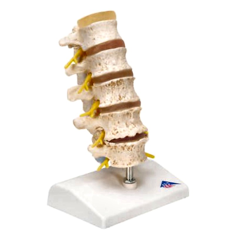 Vertebra Lumbar Spine Anatomical Model - Degenerative Changes Disc Protrusions Disassemblable 3B Scientific