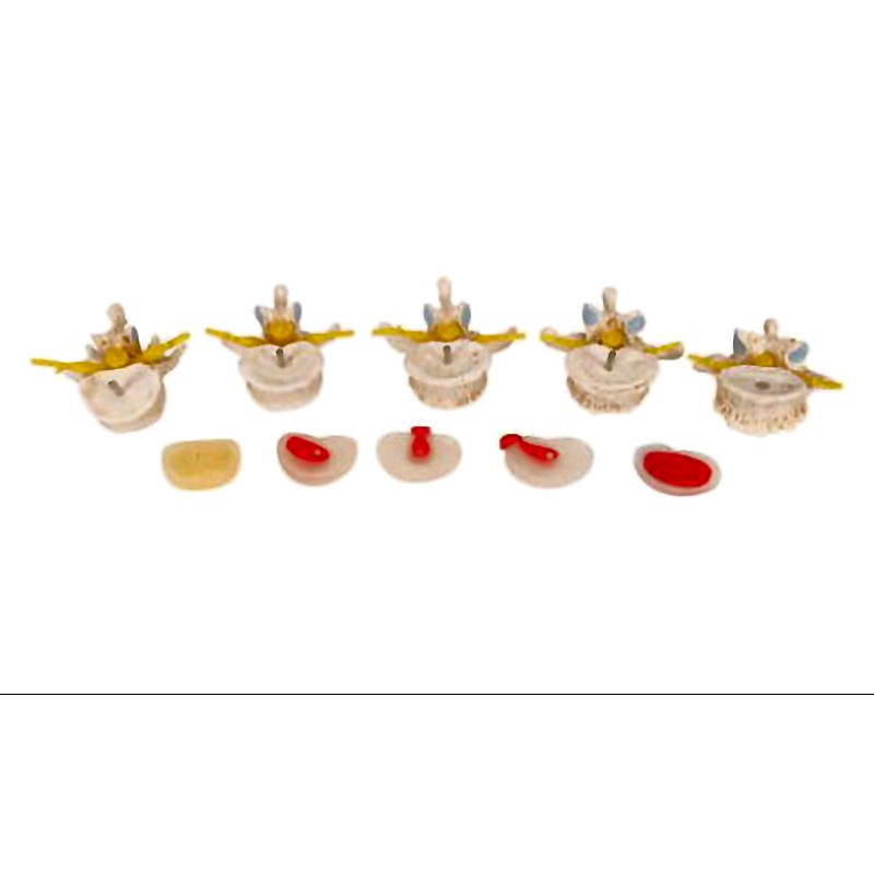 Vertebra Lumbar Spine Anatomical Model - Degenerative Changes Disc Protrusions Disassemblable 3B Scientific