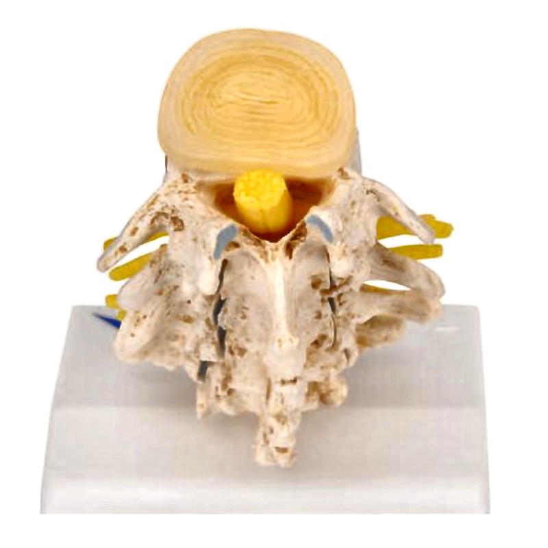 Vertebra Lumbar Spine Anatomical Model - Degenerative Changes Disc Protrusions Disassemblable 3B Scientific