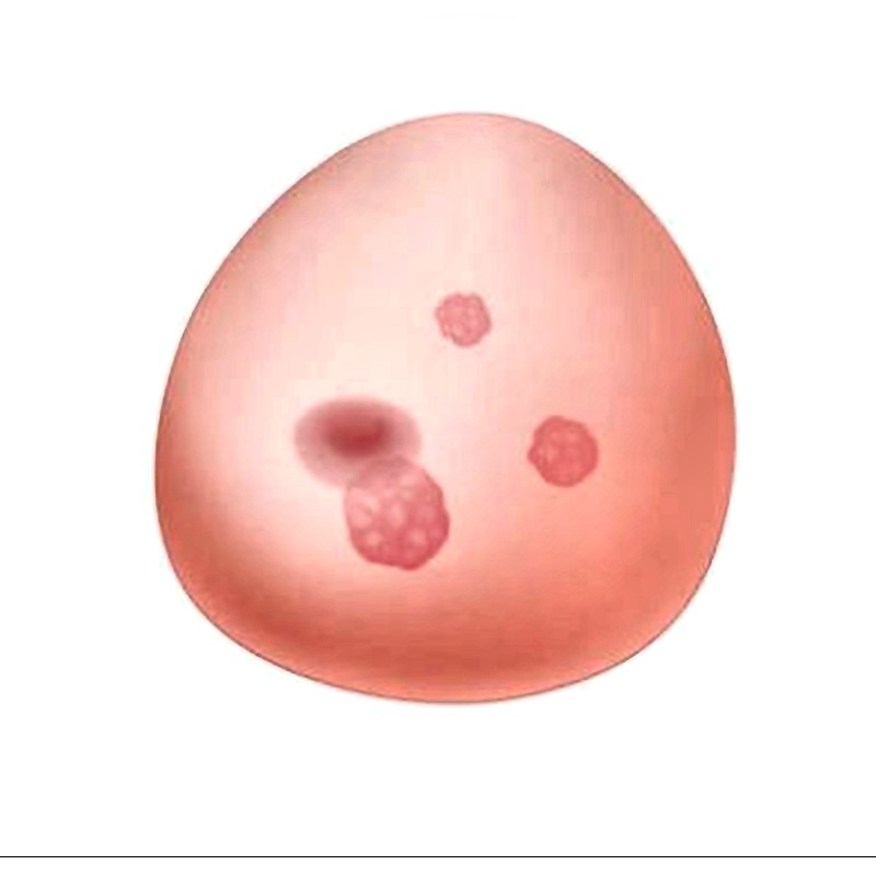 SONOtrain Breast Ultrasound Simulator with 3 Tumors