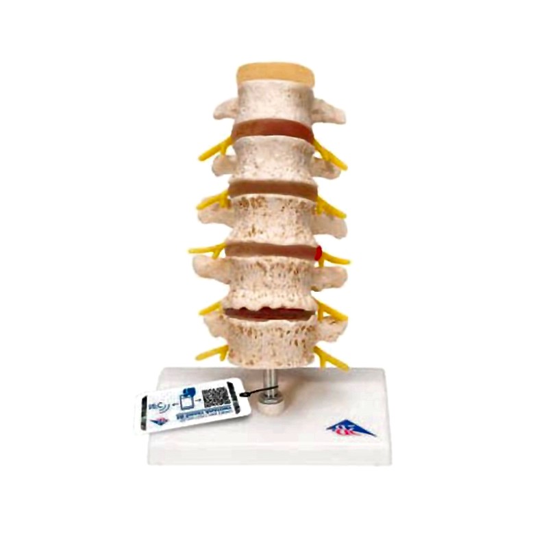 Vertebra Lumbar Spine Anatomical Model - Degenerative Changes Disc Protrusions Disassemblable 3B Scientific